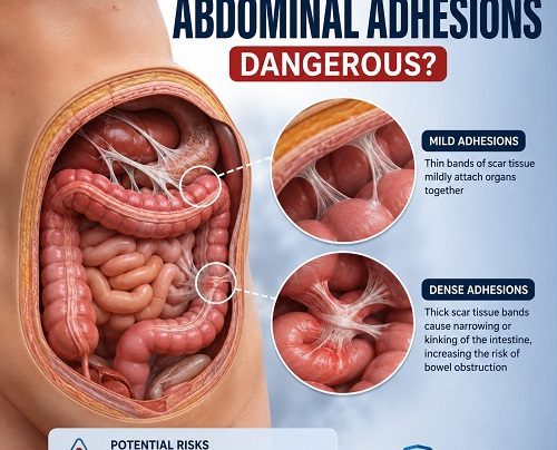 Are abdominal adhesions dangerous showing scar tissue restricting intestinal loops