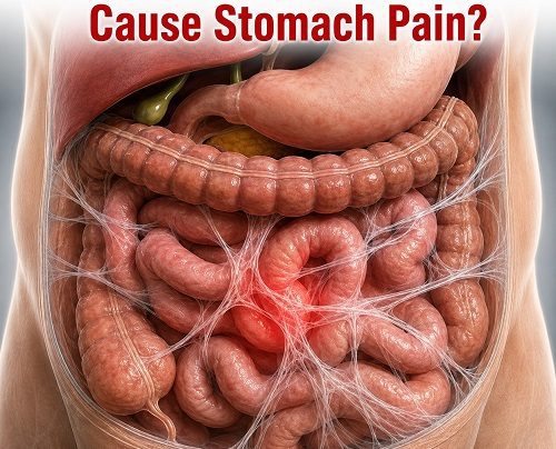 Medical illustration showing abdominal adhesions causing abdominal pain around the intestines