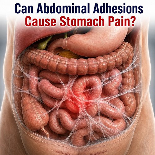 Can Abdominal Adhesions Cause Stomach Pain?