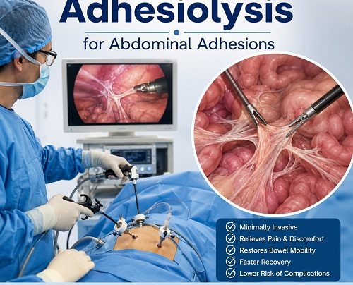 Laparoscopic adhesiolysis for abdominal adhesions showing a surgeon releasing scar tissue around intestinal loops