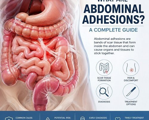 Medical illustration showing abdominal adhesions and scar tissue connecting sections of the intestine