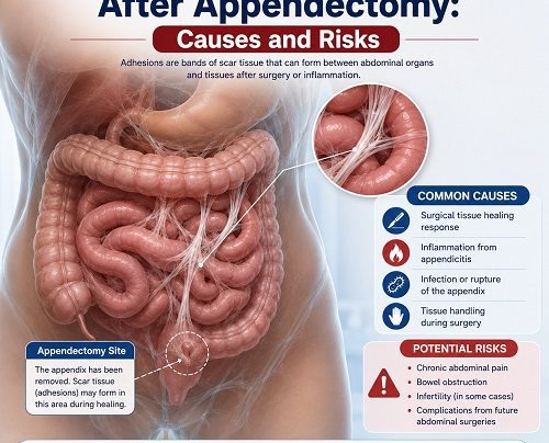 Abdominal Adhesions After Appendectomy