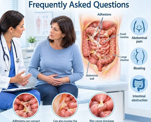 Abdominal Adhesions FAQ showing scar-like tissue connecting abdominal organs and causing digestive symptoms