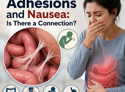 Medical illustration showing abdominal adhesions affecting the intestines and causing nausea