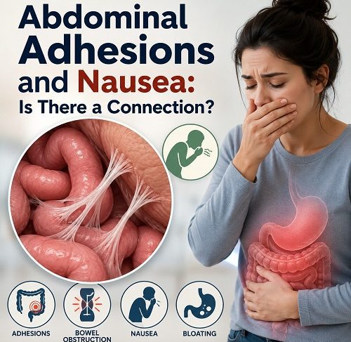 Medical illustration showing abdominal adhesions affecting the intestines and causing nausea