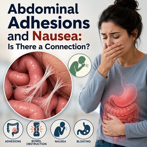 Abdominal Adhesions and Nausea: Is There a Connection?