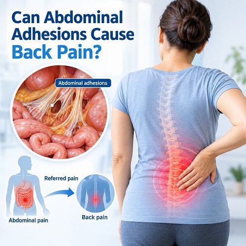 Can Abdominal Adhesions Cause Back Pain?