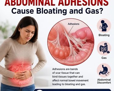 Abdominal adhesions causing bloating and gas by affecting intestinal movement