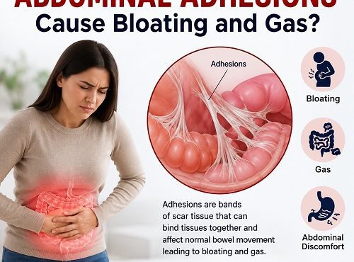 Abdominal adhesions causing bloating and gas by affecting intestinal movement