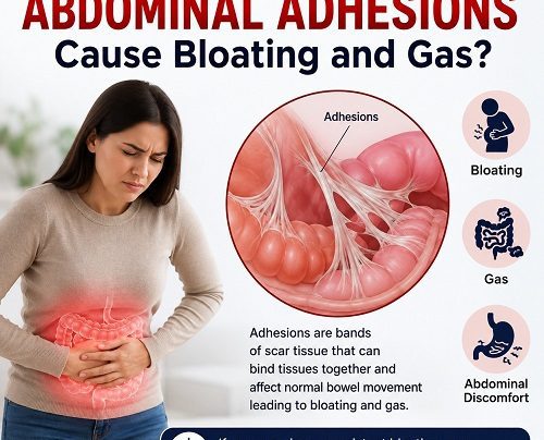 Abdominal adhesions causing bloating and gas by affecting intestinal movement