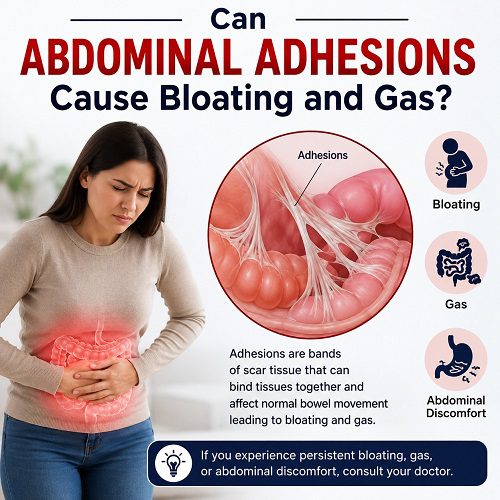 Can Abdominal Adhesions Cause Bloating and Gas?