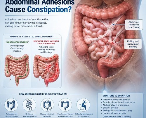 Medical illustration showing abdominal adhesions affecting the intestines and contributing to constipation
