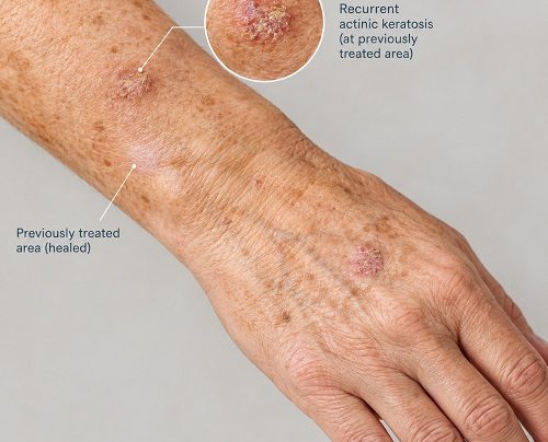 Actinic keratosis recurring on sun-damaged skin after treatment