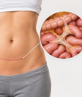Abdominal scar tissue and adhesions forming after surgery