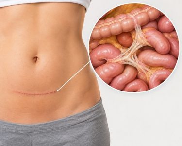 Abdominal scar tissue and adhesions forming after surgery