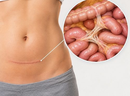 Abdominal scar tissue and adhesions forming after surgery