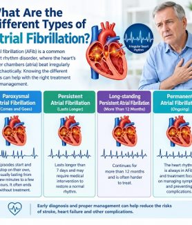 Medical illustration showing the different types of atrial fibrillation and irregular heart rhythms.