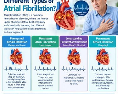 Medical illustration showing the different types of atrial fibrillation and irregular heart rhythms.