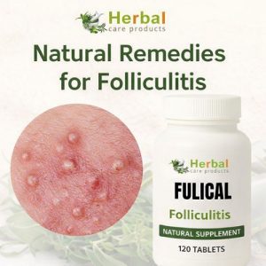 Natural Remedies for Folliculitis