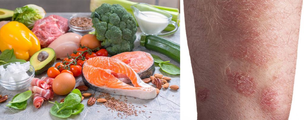 Actinic Keratosis Diet Foods to Eat and Avoid