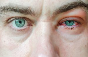 How to Cure Blepharitis Fast