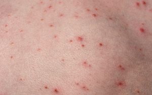 How do you get rid of long term Folliculitis