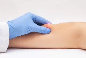 How to Remove a Lipoma Fast And Easily