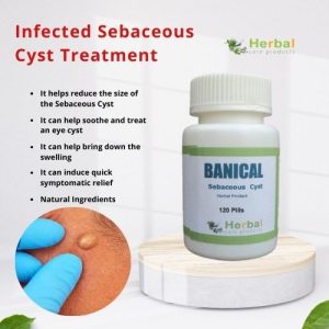 Sebaceous Cyst